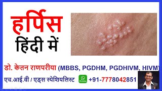 HSV 1 2 Herpes Simplex Virus Symtoms Exposure Transmission IgG Test Positive Result in Hindi