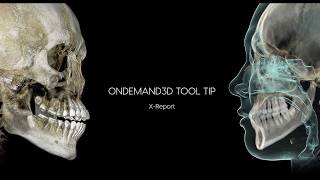 Cybermed OnDemand3D Tool Tip- X report