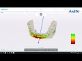 cameo rapid 3 intraoral scanner restoration scan