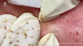 Big Cystic Acne Blackheads Extraction Blackheads \u0026 Milia, Whiteheads Removal Pimple Popping