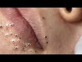 Big Cystic Acne Blackheads Extraction Blackheads & Milia, Whiteheads Removal Pimple Popping # 9248