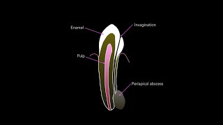 RCT invaginated UL2 preserving vitality