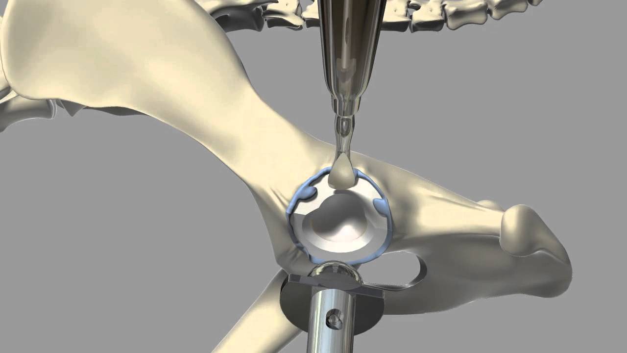 Total Hip Replacement - YouTube