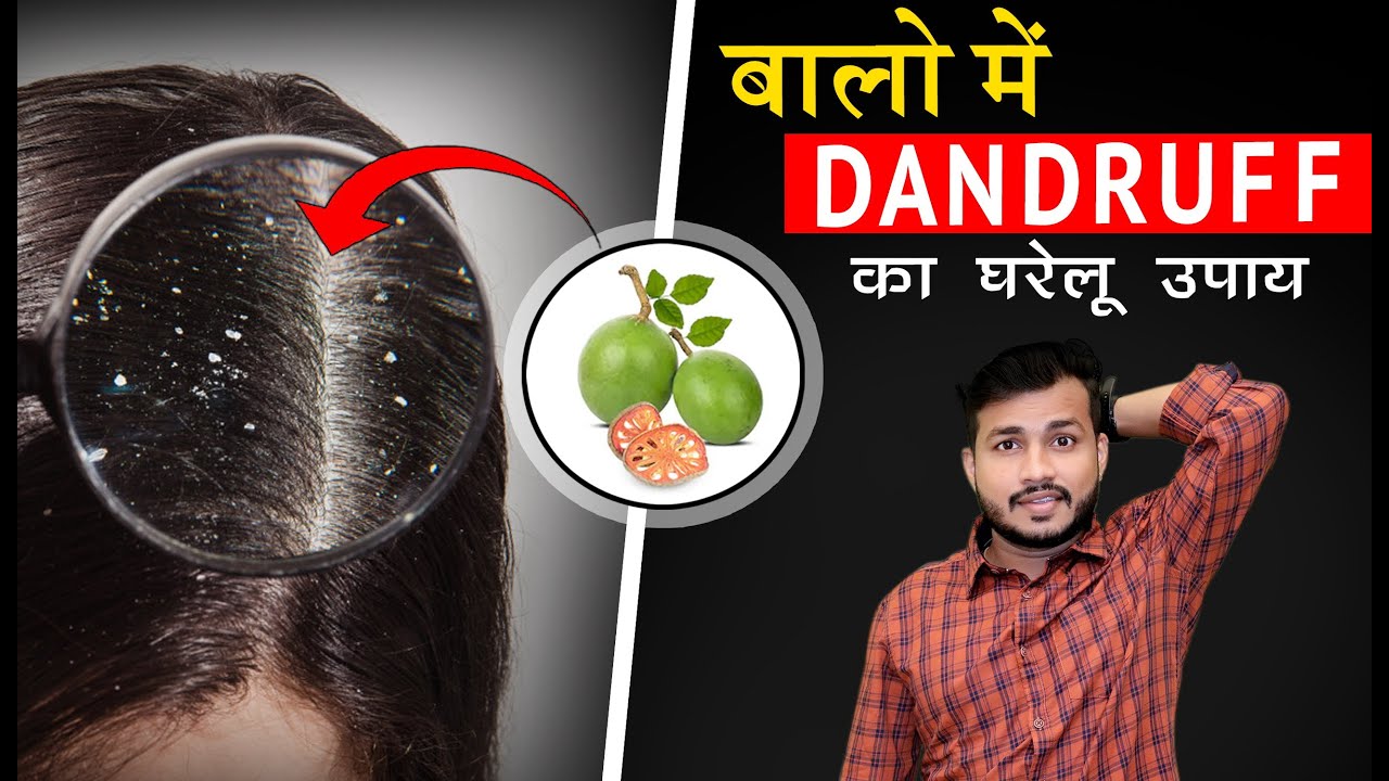 17:Dandruff में सही आयुर्वेद और असरदार घरेलू उपचार। Dandruff Treatment ...