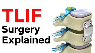 TLIF Surgery Explained with 3D Animation | Transforaminal Lumbar Interbody Fusion | Dr Sahil Batra