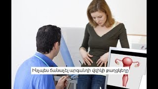 Ինչպես ճանաչել արգանդի վզիկի քաղցկեղը