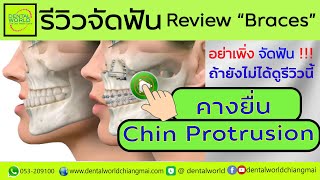 EP.52 รีวิวจัดฟันคางยื่น Chin protrusion #จัดฟันเชียงใหม่ที่ไหนดี #BracesChiangmai #chiangmaidentist