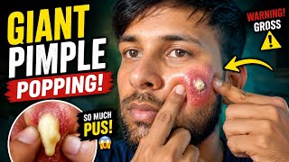 giant pimple popping