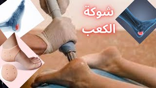 شوكة الكعب العظمية أسبابها وعلاجها/ علاج الشوكة العظمية/شوكة الكعب العظمية/علاج مسمار الكعب