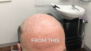 Thinning Hair Transformation in Sydney | Non-Surgical Hair System (Real Client Result)