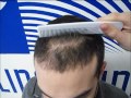 hair transplantation fue