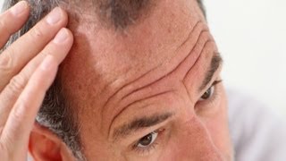Pros & Cons of Propecia (Finasteride) | Thinning Hair