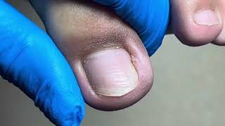 Ingrown toenail trimming and easy removal~