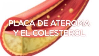 ¿Qué causa la placa de ateroma en nuestras arterias?