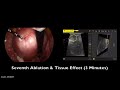 large posterior fibroid shawn tassone md