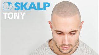 Bestfit TV featuring Skalp® Scalp micropigmentation in Manchester