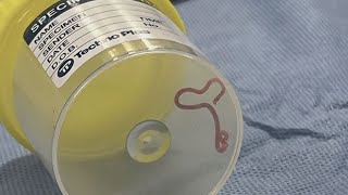 Parasitic worm found in woman's brain