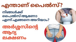 023 | എന്താണ് പൈൽസ്? എങ്ങനെ പൈൽസിനെ നേരത്തെ അറിയാം? ലക്ഷണങ്ങൾ