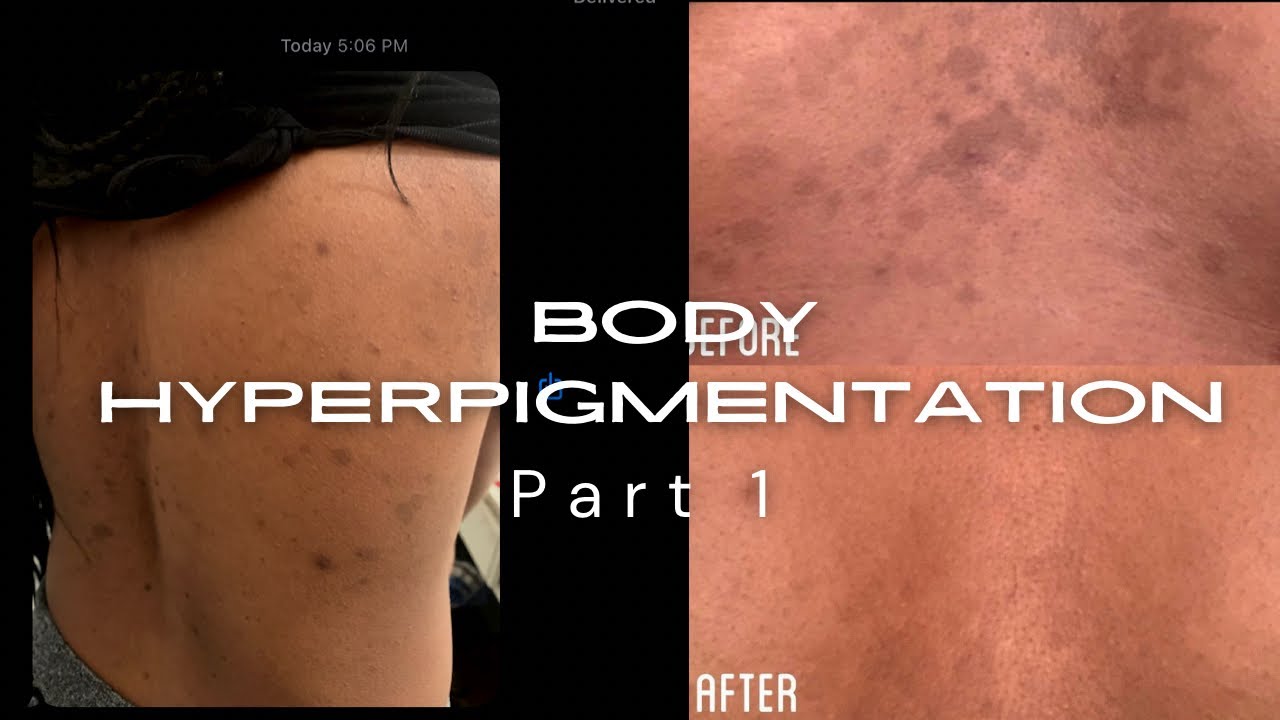 Body Hyperpigmentation Part 1 пёџ Youtube
