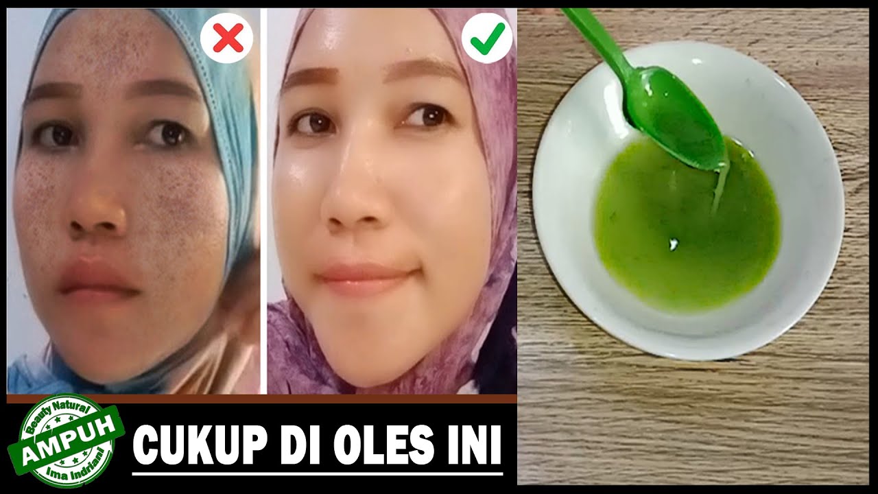 Cara Menghilangkan Flek Hitam Di Wajah Dalam 1 Malam - YouTube