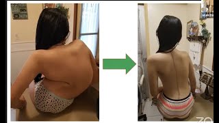 Neuromuscular Scoliosis: Techniques and Advances