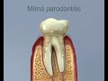 parodontitida paradentóza gum disease periodontal disease pyorrhoea