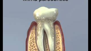 Parodontitida (paradentóza) / Gum Disease/ Periodontal Disease/ Pyorrhoea