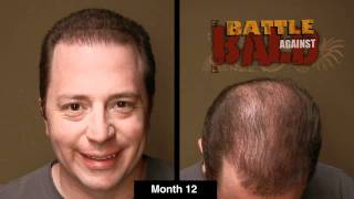 Bosley Hair Transplant Results After 12 Months (Time Lapse)