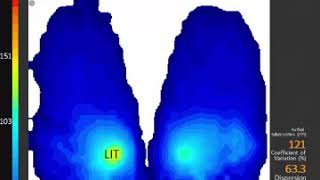 ForeSite SS Pressure Mapping to Prevent Pressure Sores