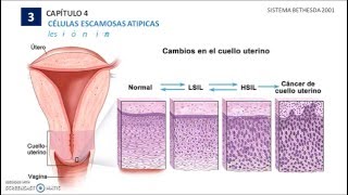 3  Sistema Bethesda 2001 Para Informar la Citología Cervical