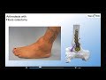 paragon 28 surgeon led webinars  ankle and ttc fusion with plates – myerson