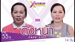 รีวิวดึงหน้า Face Lift : ขอขัดใจสามี...เพราะอยากเห็นใบหน้าตัวเองที่สวยขึ้น