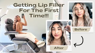 Lip Filler Vlog | My experience + Before \u0026 After