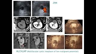 CEUS of problematic renal masses, cystic