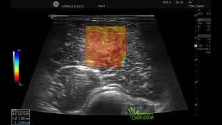 Elastografía shear wave en edema muscular DOMS en braquioradial.