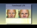 Introduction to Forehead Lift with Dr. Lawrence G. Kass, M.D