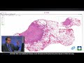 pathology insights lung granulomas caused by fungal infection with sanjay mukhopadhyay md