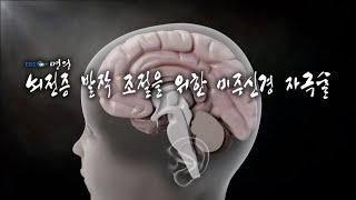 [명의 의학백과📖] 뇌전증 발작 조절을 위한 미주신경 자극술