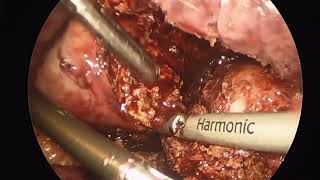 Difficult Laparoscopic Cholecystectomy for Porcelain Gallbladder in a Morbidly Obese Patient