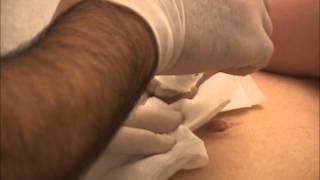 Cryogenic Removal of a very large Keloid, keloid treatment New York