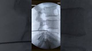 Fluoroscopic View of Percutaneous Disk Decompression Procedure