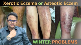 Xerotic Eczema or Asteotic Eczema | By Dr. Uttam Kumar Lenka MBBS, MD (Consultant Dermatologist)