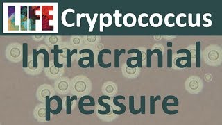 Raised intracranial pressure in cryptococcosis