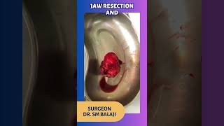 Jaw Resection and Reconstruction - Dr. SM Balaji, Maxillofacial Surgeon, India