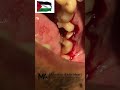 surgical extraction of lower first molar.