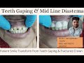 How Porcelain Crown can fix your Midline Diastema or teeth gap in just two appointment#diastema #yt