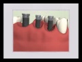 multi implant animation biomet 3i