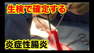 生検で確定する炎症性腸炎（IBD）