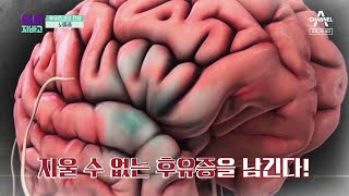 [예고] 예고 없이 찾아오는 불청객, 뇌졸중을 잡아라! | TV 주치의 닥터 지.바.고 283 회