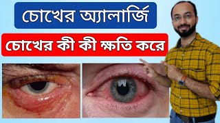 Eye Allergy Drops | Eye drop for allergy | চোখের এলার্জি দূর করার উপায় | চোখ @drarifurrahman ​